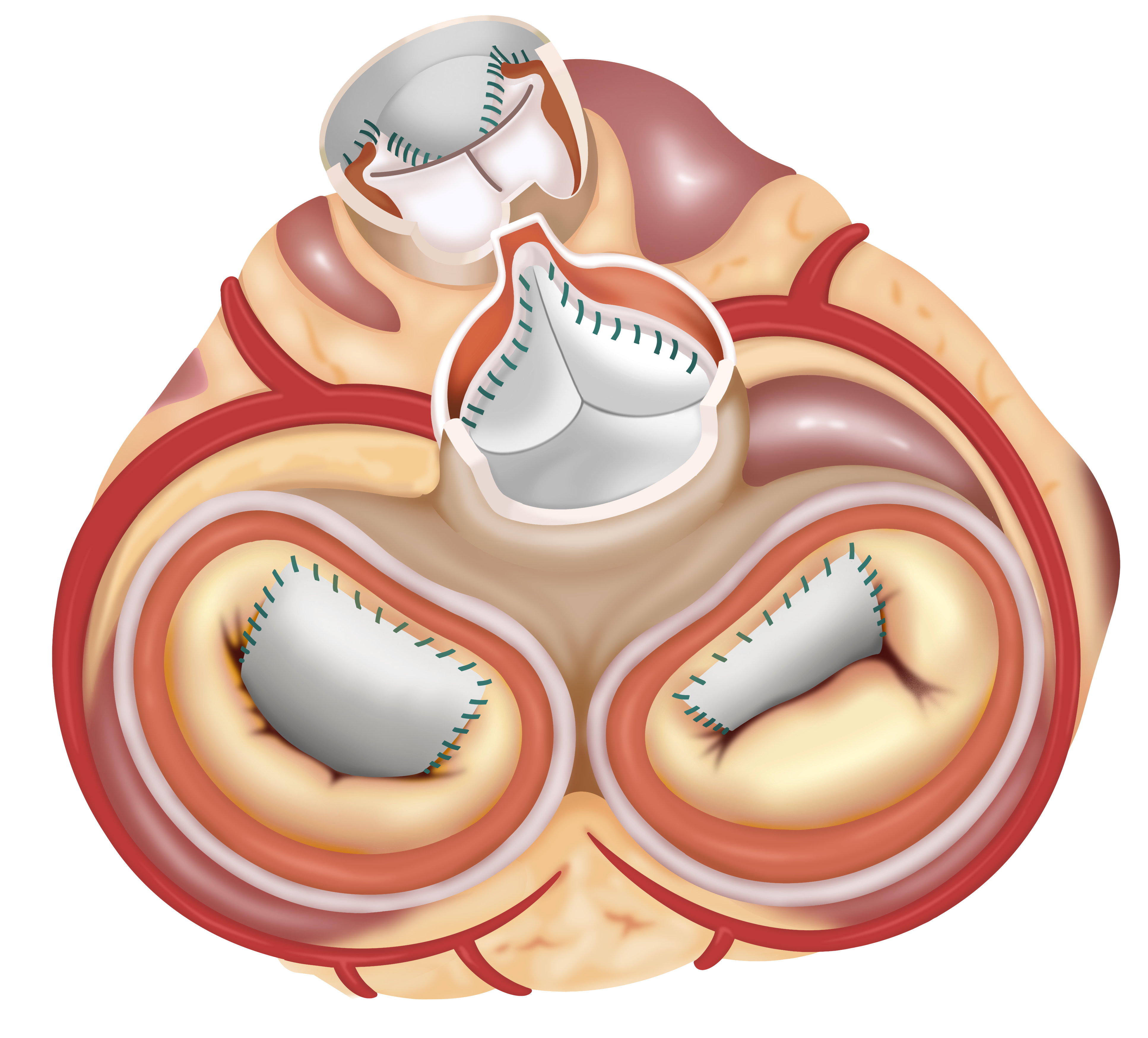 佰维复™ 心脏瓣膜生物补片